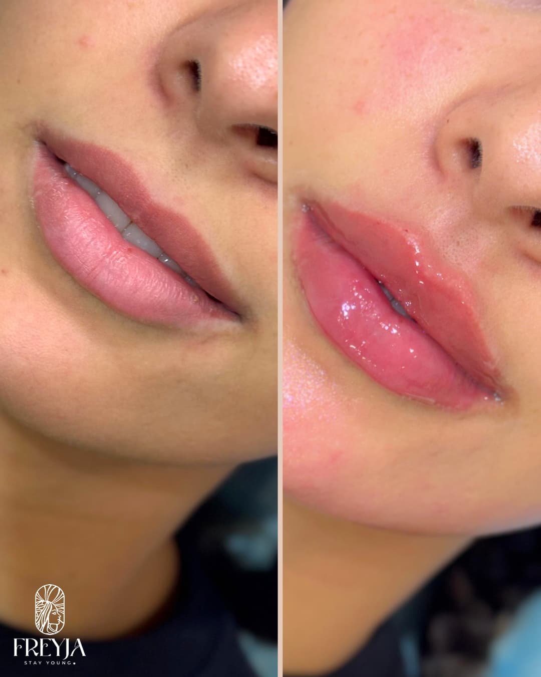 Lip Filler – Natural Result