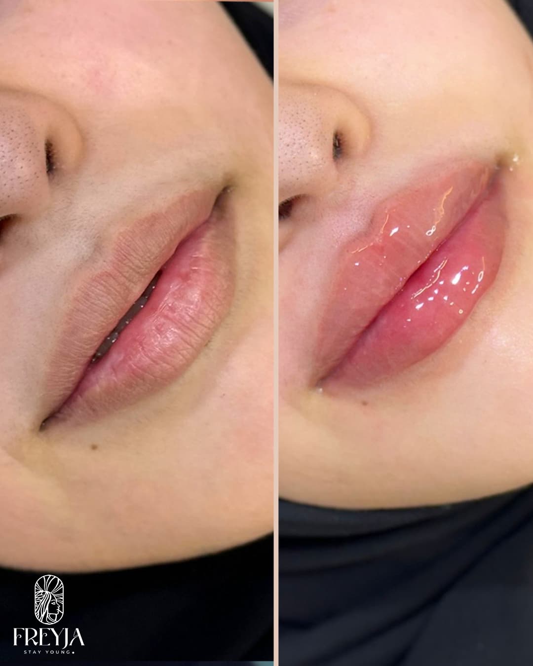 Lip Filler – Volume Enhancement