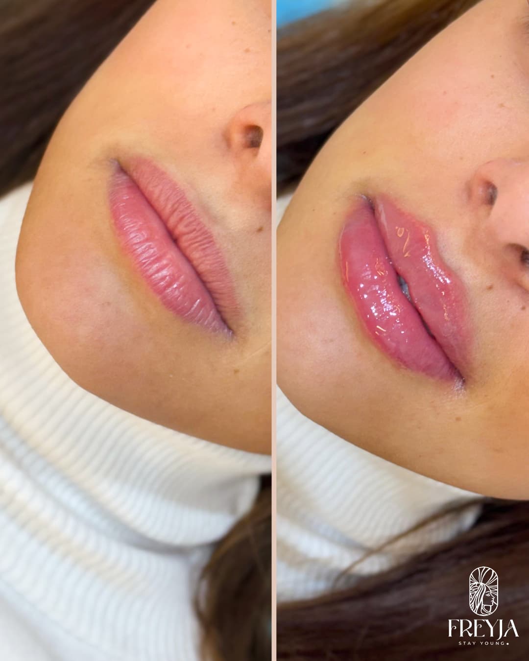 Lip Filler – Shape Symmetry