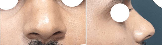 تجميل الأنف - الملف الجانبي - قبل العملية