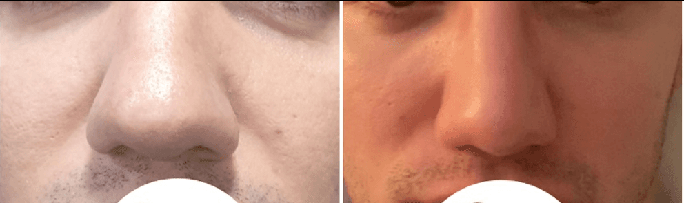 تجميل الأنف - قبل العملية