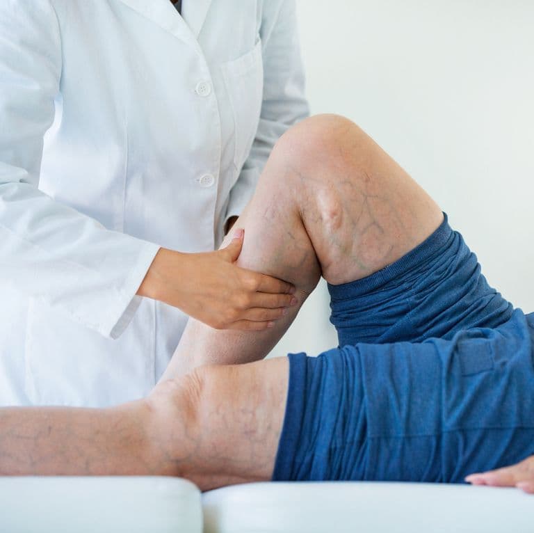 Laser/Radiofrequency Ablation of Varicose Vein - One Leg