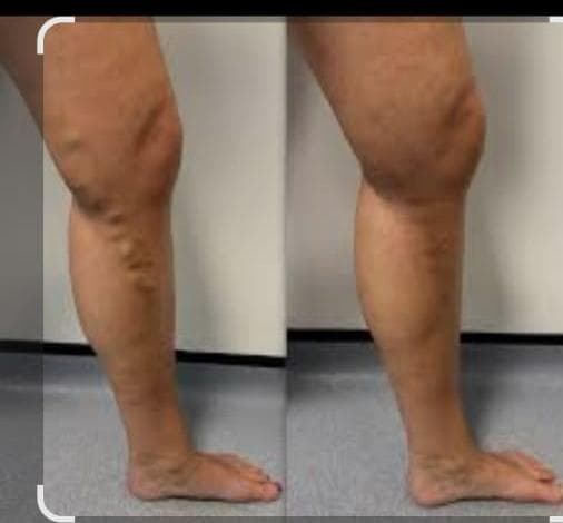 Varicose Veins – Lateral View