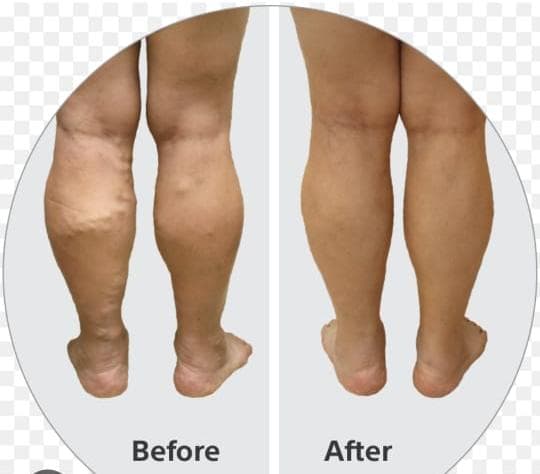 Varicose Vein Removal – Visible Improvement