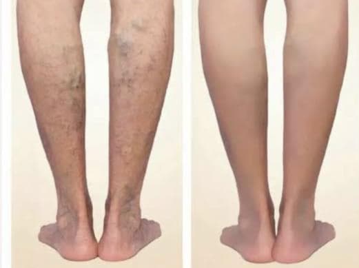 Leg Varicose Veins – Posterior View