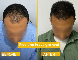 نتيجة زراعة الشعر قبل وبعد - تكثيف خط الشعر الأمامي