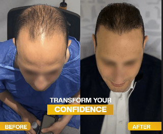 نتيجة زراعة الشعر قبل وبعد - تغطية منطقة التاج