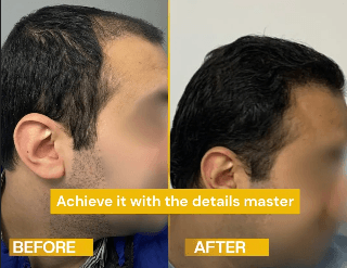 نتيجة زراعة الشعر قبل وبعد - تكثيف الجانبين والمقدمة