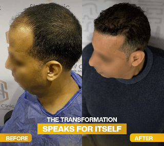نتيجة زراعة الشعر قبل وبعد - تكثيف الصدغين والمقدمة