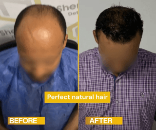نتيجة زراعة الشعر قبل وبعد - تغطية صلع كامل بالمقدمة والتاج